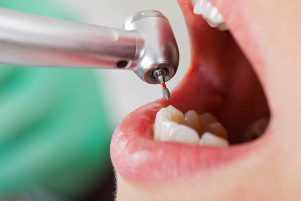 Best Broken or Chipped Tooth Repair in Dixon, CA